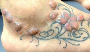¿Qué es la intoxicación por tinta de tatuaje?