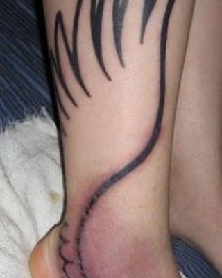 Fotos de cicatrices de tatuajes