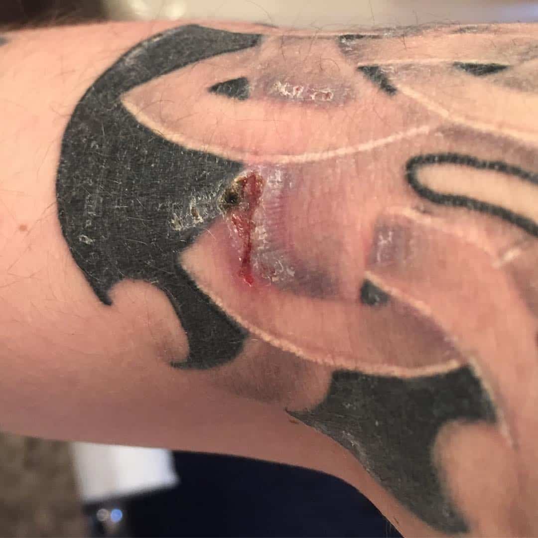 Fotos de cicatrices de tatuajes