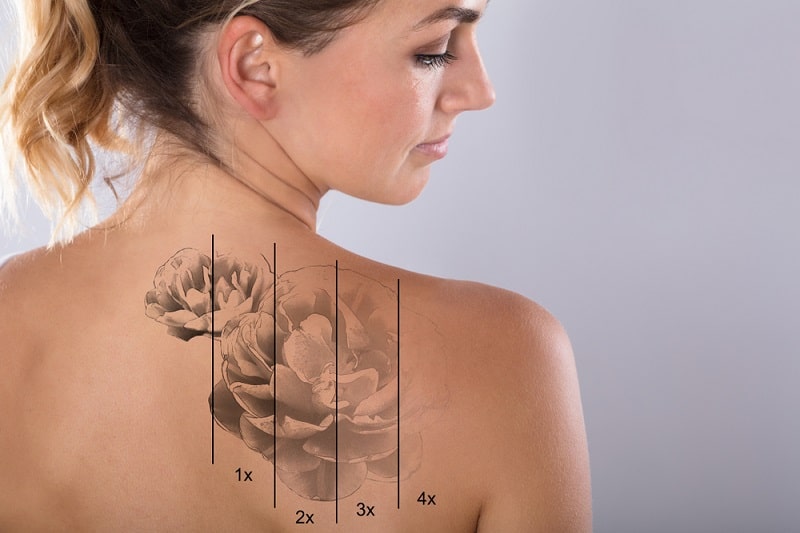 Cómo funciona la eliminación de tatuajes con láser