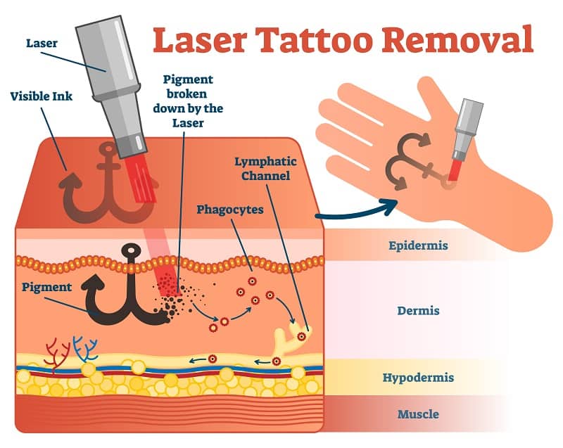 Longitudes de onda, pulsos y energía de la eliminación de tatuajes con láser