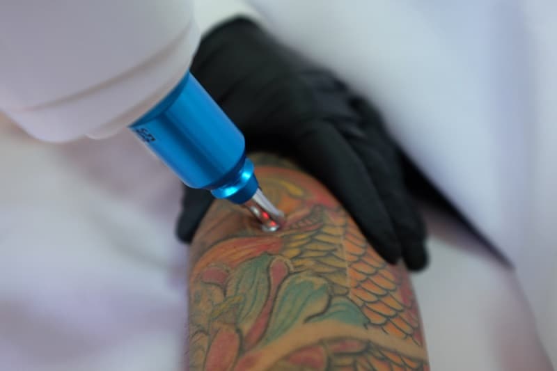 Preguntas frecuentes sobre la eliminación de tatuajes con láser