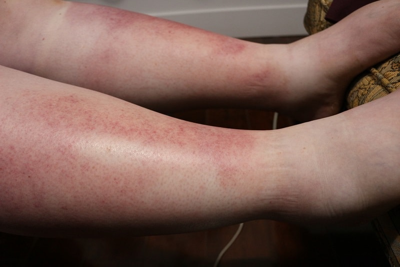 Terrible quemadura de sol en la pierna de las hembras que ha causado envenenamiento por el sol