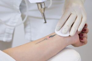 Las mejores máquinas de eliminación de tatuajes con láser para Zap That Tattoo en 2022
