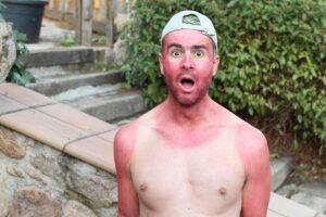 ¿Puedes tatuarte si tu piel se está pelando por las quemaduras solares?