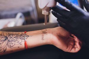 ¿La eliminación de tatuajes causa cicatrices? Eliminación de tatuajes con láser y efectos secundarios