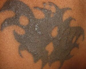Granulomas y Tatuajes: Causas, Síntomas y Tratamiento