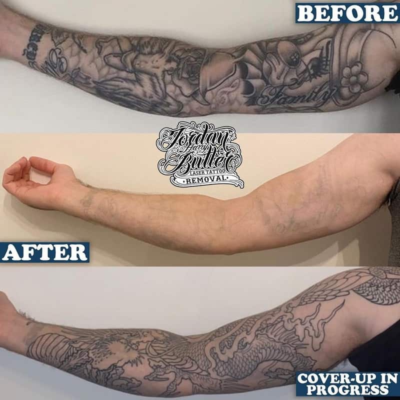 eliminación de tatuajes con láser y cubrir con un nuevo tatuaje