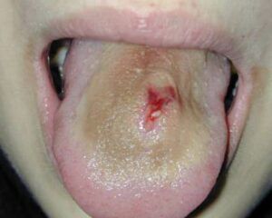 Sangrado por perforación de la lengua: causas y tratamiento
