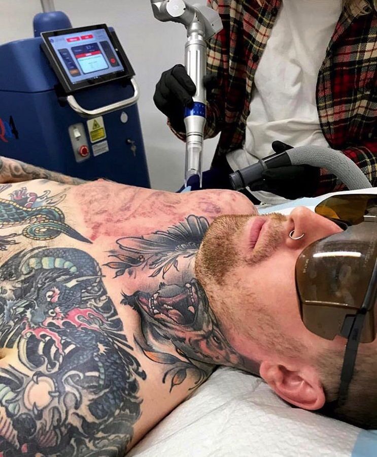 Por que la eliminacion de tatuajes requiere varias sesiones