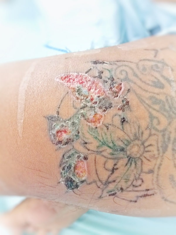Infección del tatuaje Dermatitis