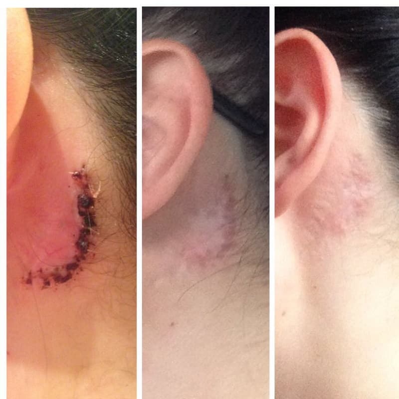 Después de la eliminación quirúrgica de un tatuaje con una cicatriz