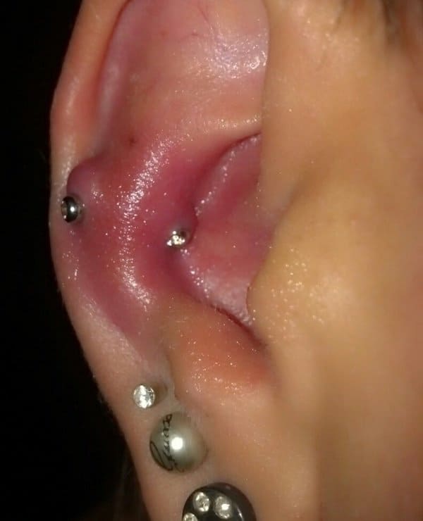 1656868789 913 Tratamiento de un piercing en la oreja infectado sin que