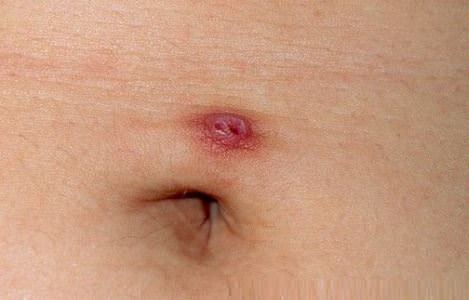 Infección del piercing del ombligo