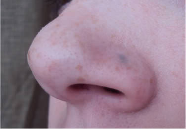 Cicatriz perforante de la nariz