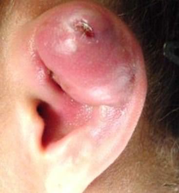 1657215069 803 Infecciones en una perforacion de oreja mas vieja
