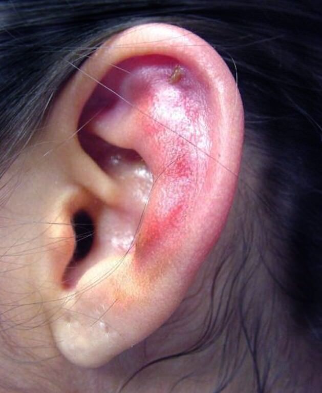 1657227732 624 Piercings de oreja infectados causas y tratamiento