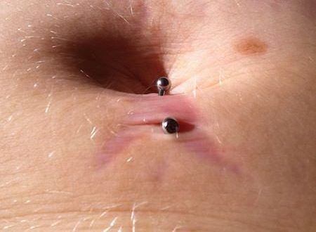 Belly Button Piercing Infected e1507907935809