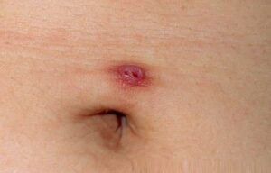 Piercing en el ombligo: causas y tratamiento