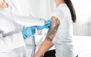 ¿Se puede quitar un tatuaje naturalmente?
