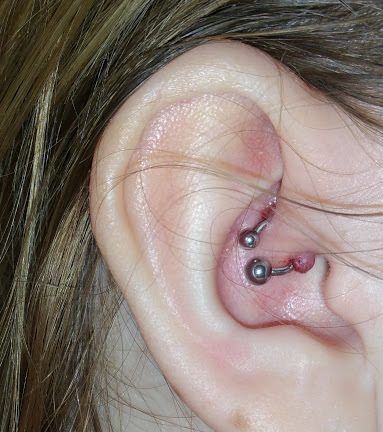 Cartilage Piercing Keloid e1574527878504