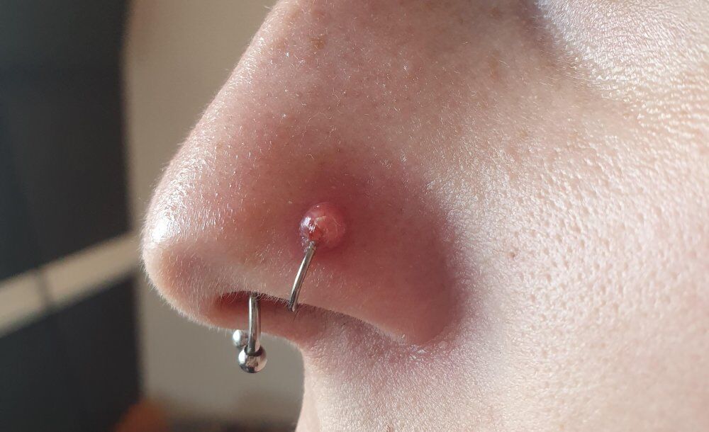 Cicatrices de perforacion de la nariz causas y tratamiento