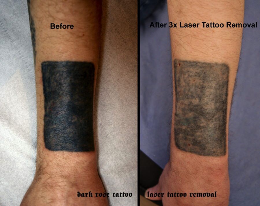 Costos de eliminacion de tatuajes ¿Cuanto cuesta la eliminacion de
