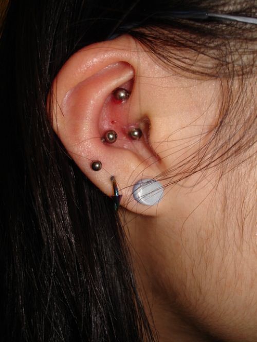 Daith Piercing Infection