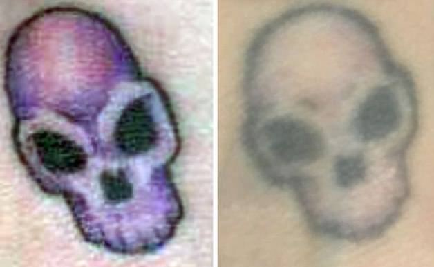 Desvanecimiento del tatuaje