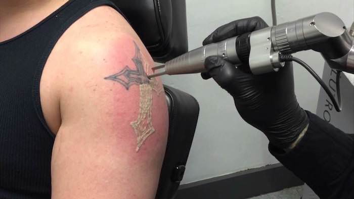 Dolor por eliminacion de tatuajes con laser ¿cuanto duele