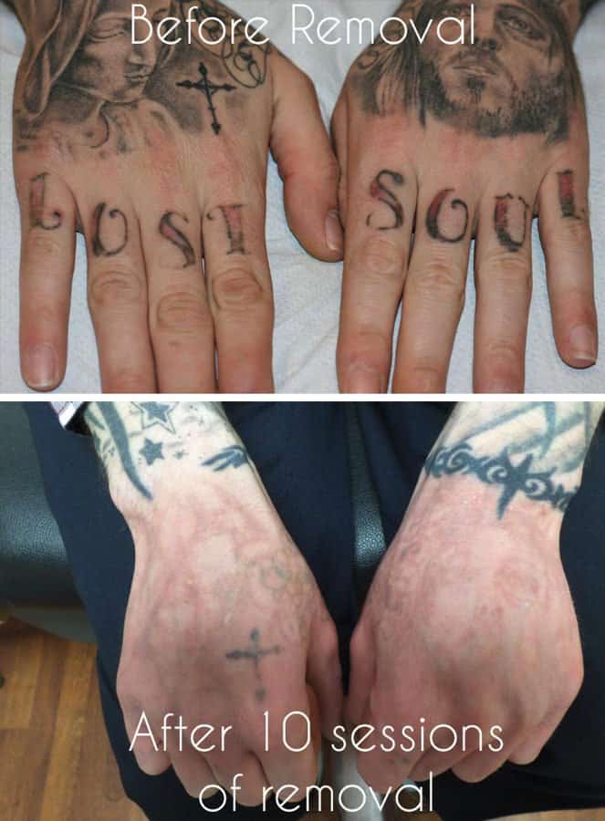 Eliminacion de tatuajes con laser todo lo que necesita saber