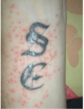 Erupcion del tatuaje sintomas causas y tratamiento