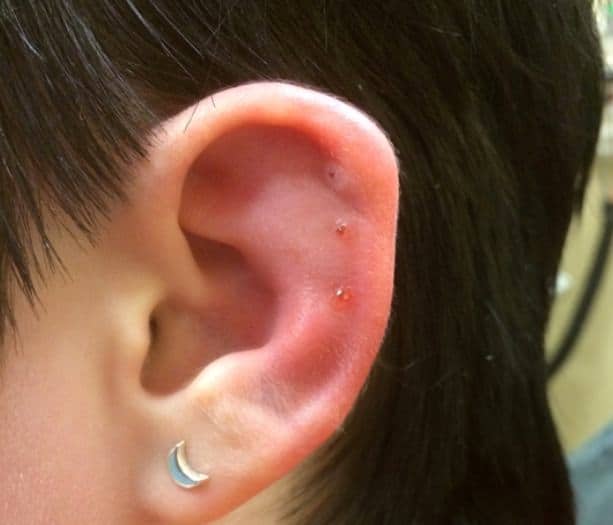 Infected Cartilage Piercing