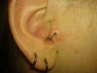 Infected Tragus Piercing 3