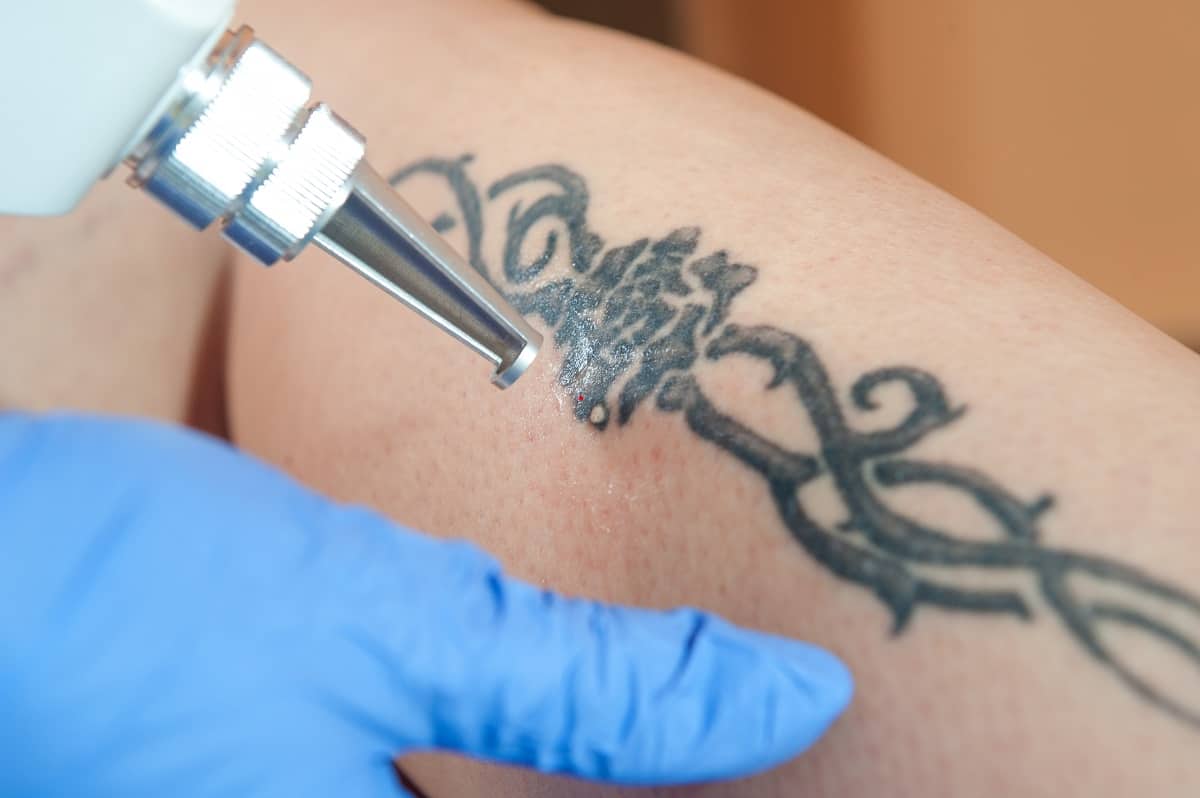 Is Laser Tattoo Removal