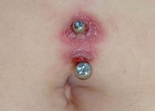 Piercing en el ombligo infectado