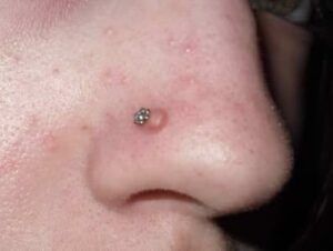 Piercing en la nariz: 6 causas y cómo tratarlas