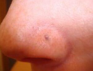 Cicatrices de perforación de la nariz: causas y tratamiento
