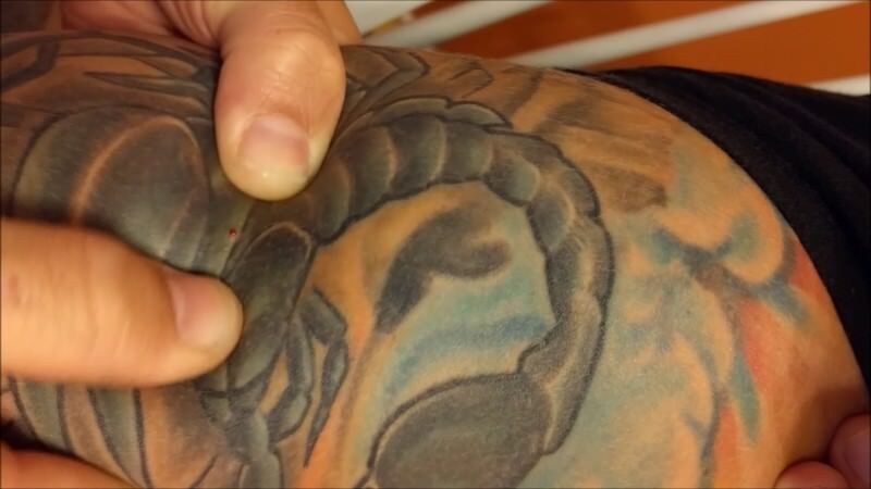 Pelos encarnados en un tatuaje causas y tratamiento