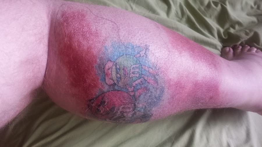 Problemas de cicatrizacion de tatuajes ¿Por que mi tatuaje no