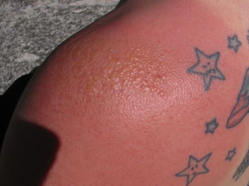 Quemaduras de sol en los tatuajes tratamiento y prevencion