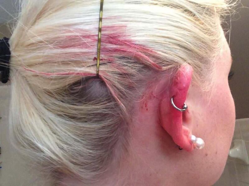 Sangrado por perforacion del oido causas y tratamiento