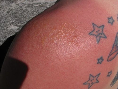 Sunburn On Tattoo