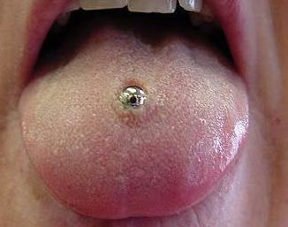 Tongue Piercing Infection 1