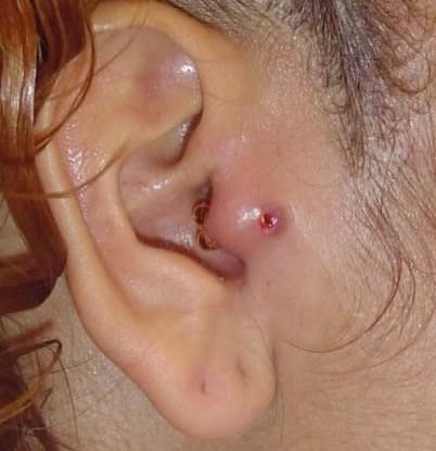 Tratamiento de un piercing en la oreja infectado sin que