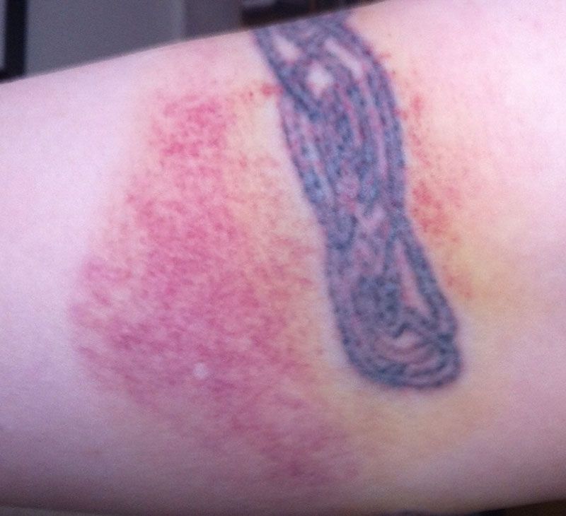 bruised tattoo 1