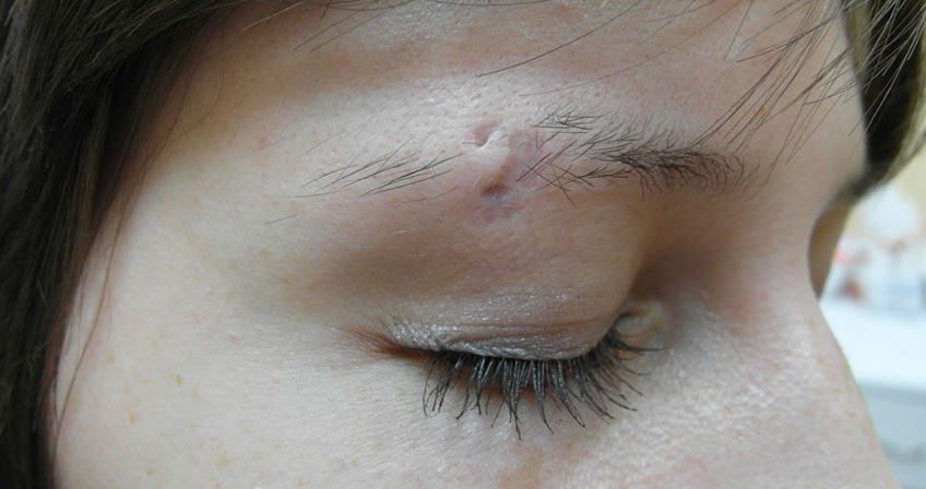 eyebrow piercing scar 2