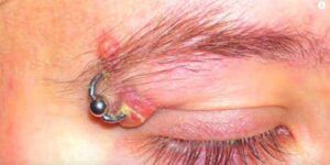 Piercings de ceja infectados - AuthorityTattoo