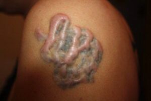 Datos del tatuaje queloide: ¿Pueden los tatuajes causar queloides?