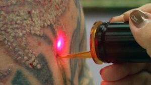 Costos de eliminación de tatuajes: ¿Cuánto cuesta la eliminación de tatuajes con láser?